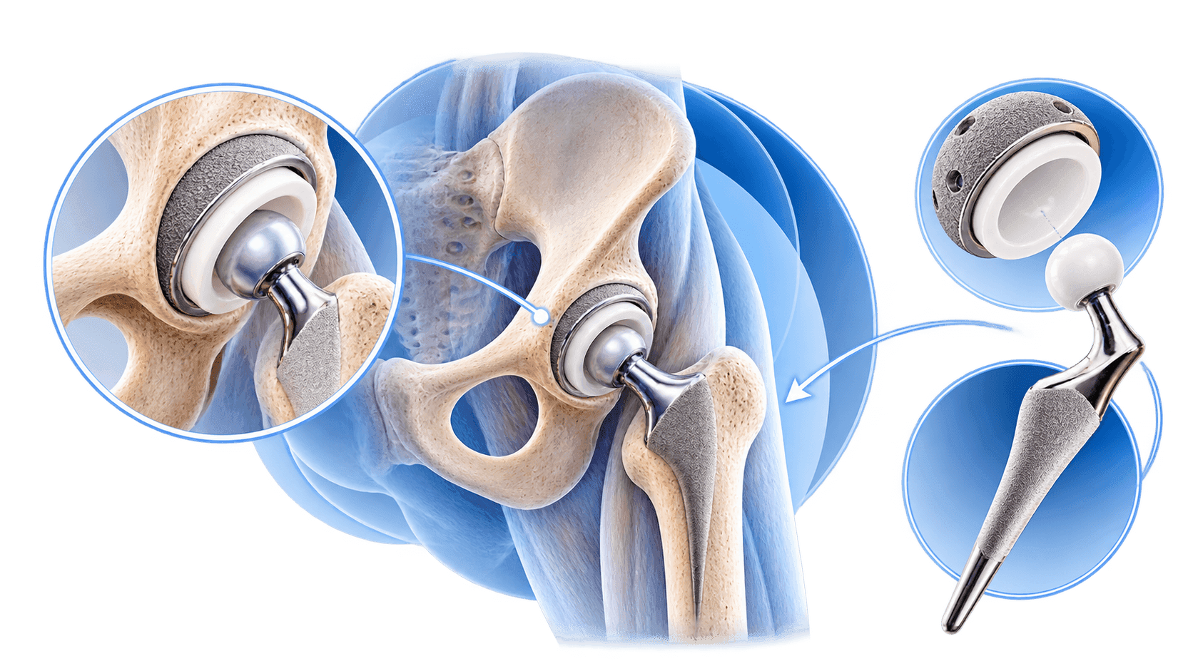 Ilustração da prótese total de quadril implantada, com o componente do acetábulo, a cabeça e a haste no fêmur